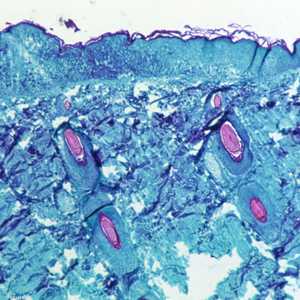 صورة مكبرة 50 مرة لأعراض فيروس جدري القردة على الجلد