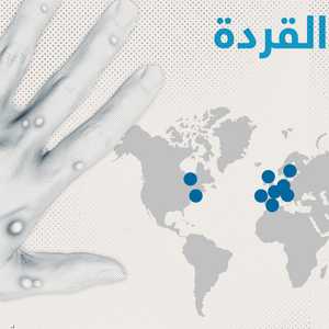 جدري القردة