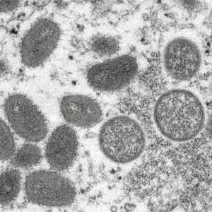 جدري القردة مرض فيروسي نادر حيوانيّ المنشأ.