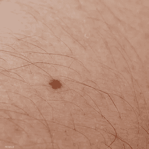 التصبغات تكشف لك سرطان الجلد بشكل مبكر