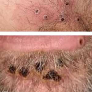 جدري القردة يتفشى ضمن فئات المثليين