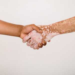 البهاق يصيب الملايين عالميا