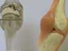 خشونة الركبة تصيب كبار السن بشكل خاص