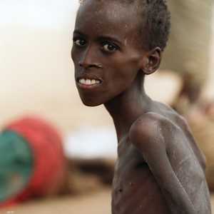 أطفال الصومال يعانون نقصا حادا في الغذاء