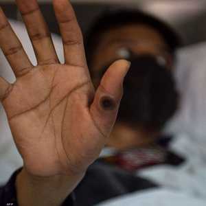 الفيروس يتسبب بظهور طفح جلدي