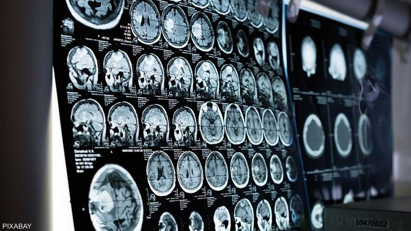 الستكتات الدماغية من بين الأمراض الخطيرة الأكثر انتشارا