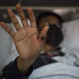 جدري القردة مرض ظهر لأول مرة في الكونغو