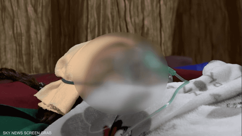 حروق الزوجة شديدة بلغت نسبتها 80 في المئة