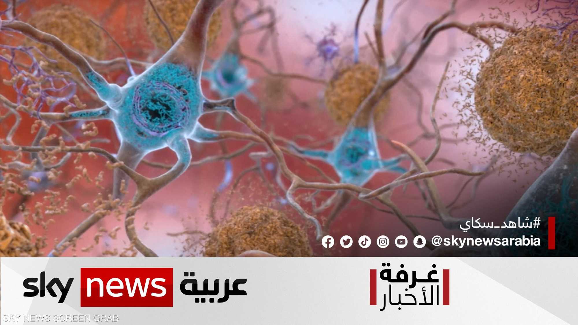 الصحة.. دواء "مبشّر" لمرض ألزهايمر