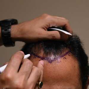 دراسة: فلاتر التواصل الاجتماعي تشجع على عمليات التجميل