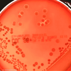 التهاب الحلق واحد من الأعراض الشائعة للمكورات العنقودية