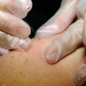 دراسة: جدري القردة يمكن أن ينتقل عبر الهواء