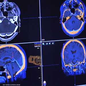 الإصابة الحادة بكورونا قد تسبب ظهور علامات الشيخوخة بالدماغ