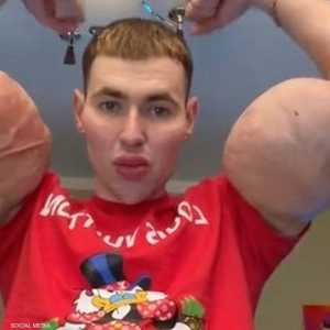 "بوباي" الروسي بعضلاته المحقونة بالزيت وأنسجة ميتة