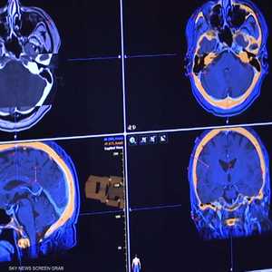 باحثون يطورون طريقة جديدة لعلاج أورام الدماغ