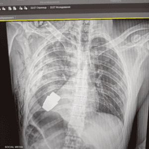 خلال العملية كان من المستحيل إجراء التخثير الكهربي
