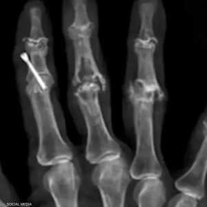 بعض من الأدوات المعدنية التي وجدها الجراح في أجساد الجرحى.