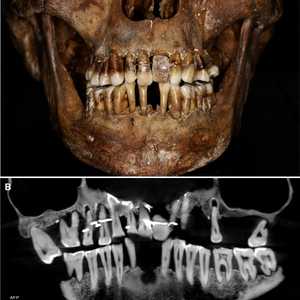 صور الأشعة السنية أظهرت وجود أسلاك ذهبية