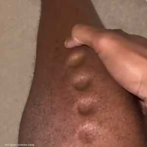 يشعر المريض بالتهاب النسيج الخلوي بارتفاع الحرارة