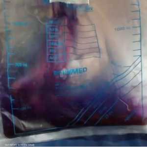 متلازمة كيس البول الأرجواني