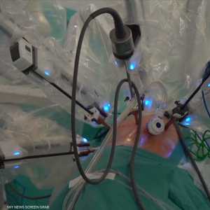 روبوت يقوم بعملية جراحية صعبة وغير مسبوقة