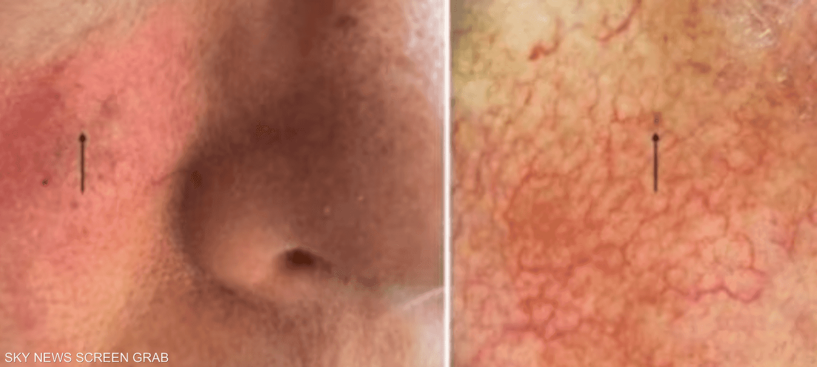 البقعة الصغيرة غير مرئية للعين البشرية وهي ورم ميلانيني