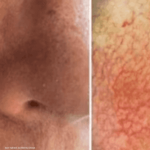 البقعة الصغيرة غير مرئية للعين البشرية وهي ورم ميلانيني