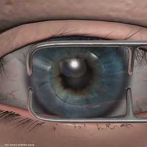 جراحات تصحيح البصر بالليزر.. تقنيات متطورة ونتائج باهرة