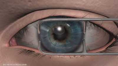 جراحات تصحيح البصر بالليزر.. تقنيات متطورة ونتائج باهرة