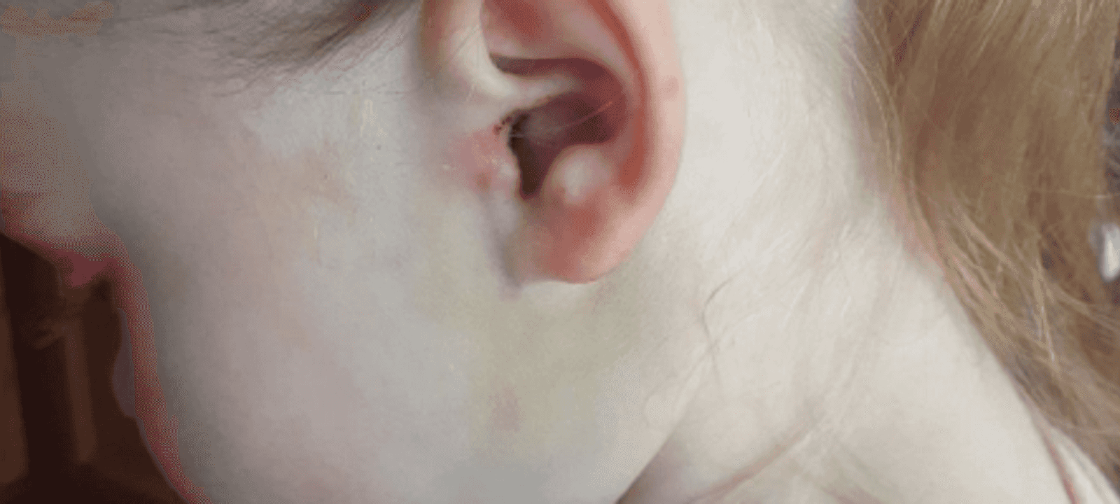 الطبيب عثر على قرادتين في أذن الطفلة