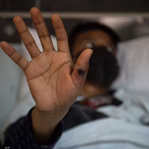 هل فعلا يمكن أن ينتقل جدري القردة عبر الملابس؟