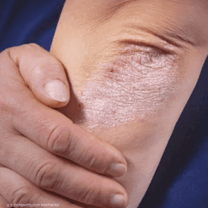 الصدفية مرض مزمن