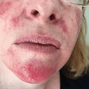 تشجع لويس الناس على إجراء الفحوصات الجلدية باستمرار