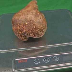 أثقل حصوة كلوية