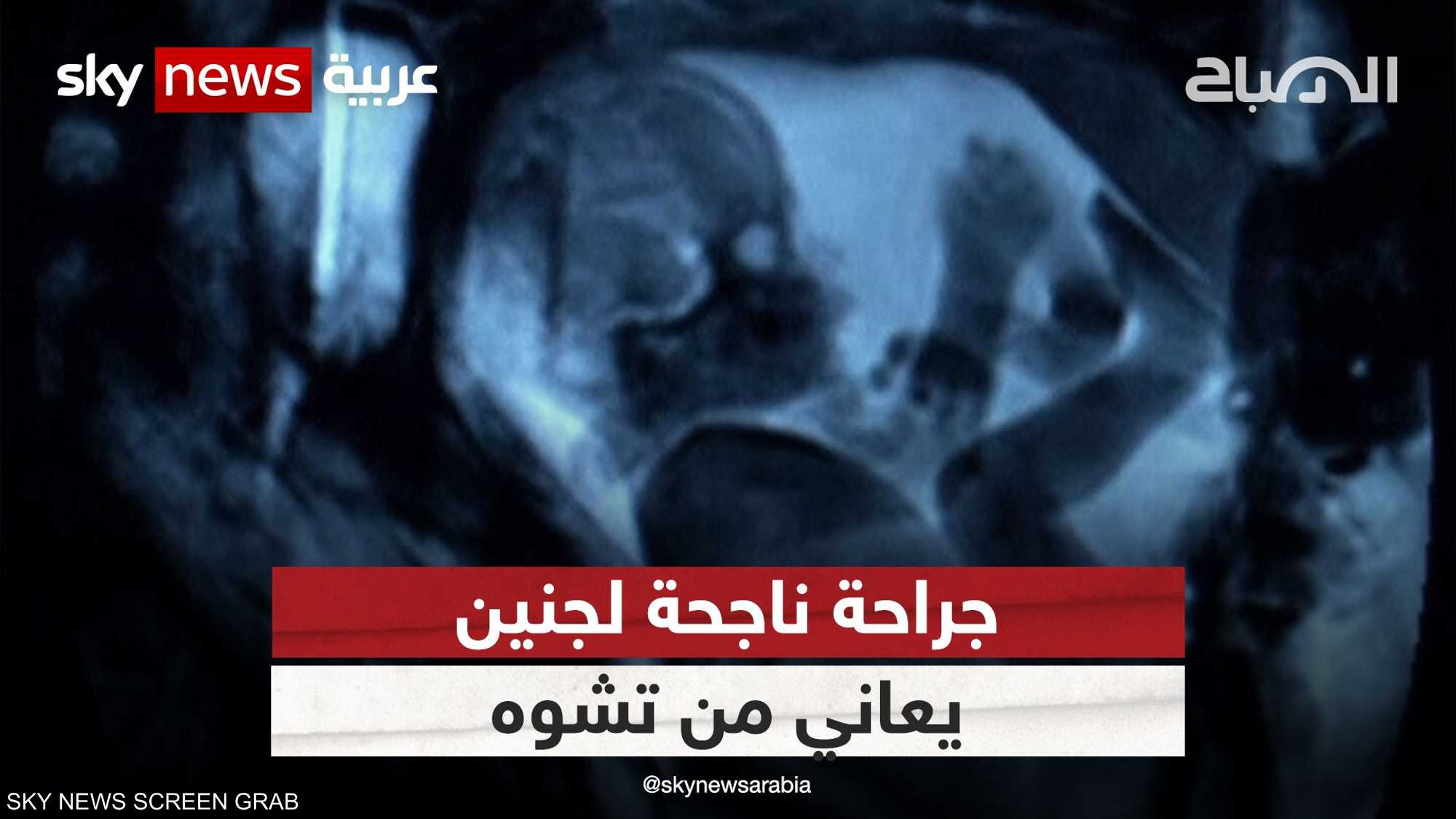 التدخل الجراحي الجنيني يجنّب حدوث مضاعفات للجنين بعد ولادته