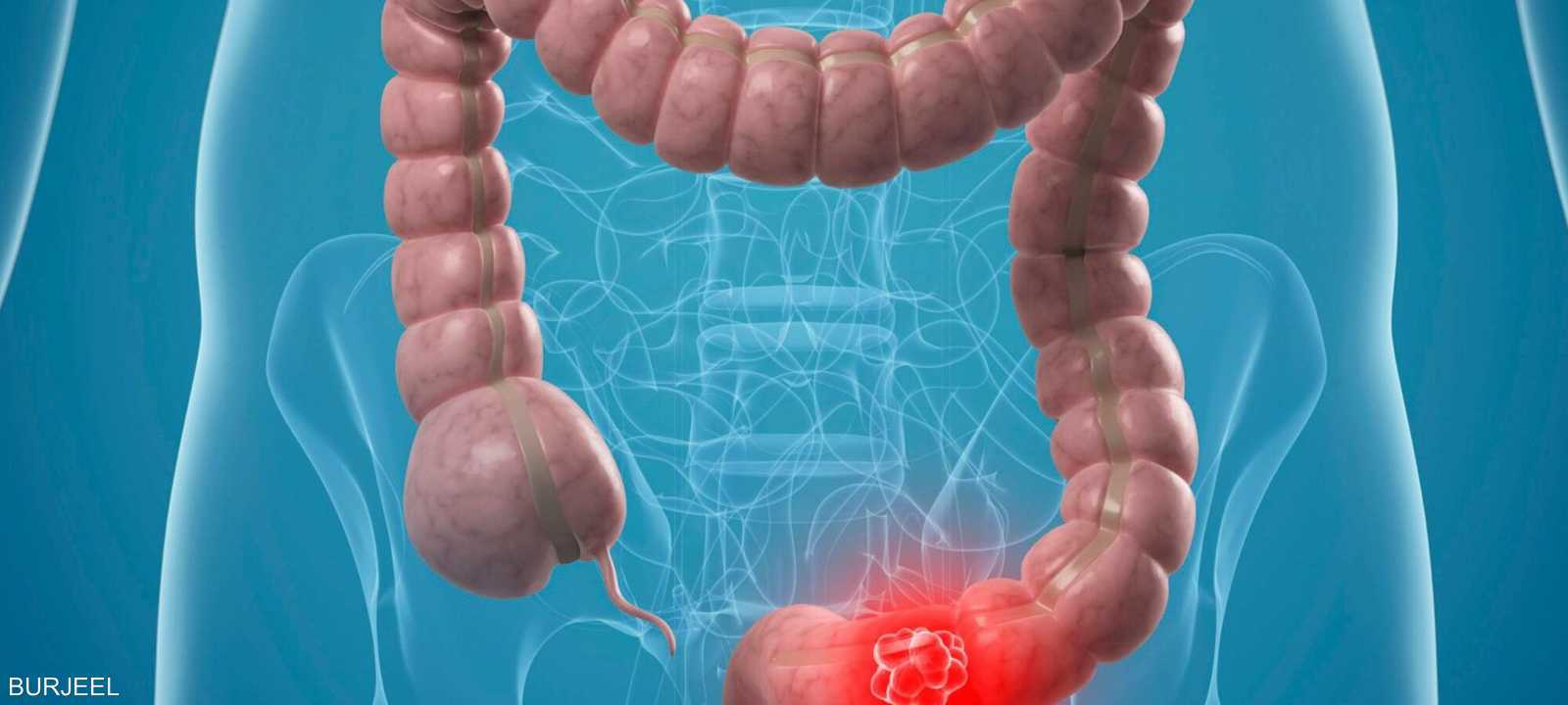 سرطان القولون يزداد بين البالغين الشباب