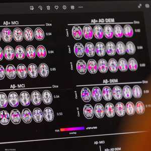 ألزهايمر.. السكر الطبيعي سبب في الإصابة