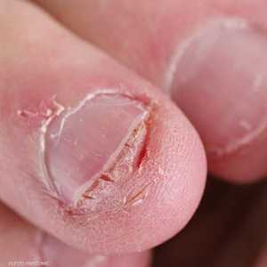 قضم الأظافر عادة سيئة