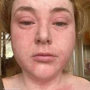 عانت الشابة من الحمى واحمرار الجلد