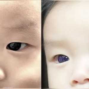تغير لون عيني الطفل من البني الداكن إلى الأزرق النيلي