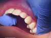 باحثون يابانيون يبشرون بعلاج يحفز إنبات أسنان جديدة للبشر