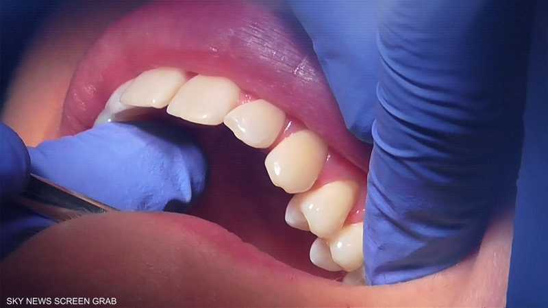 باحثون يابانيون يبشرون بعلاج يحفز إنبات أسنان جديدة للبشر