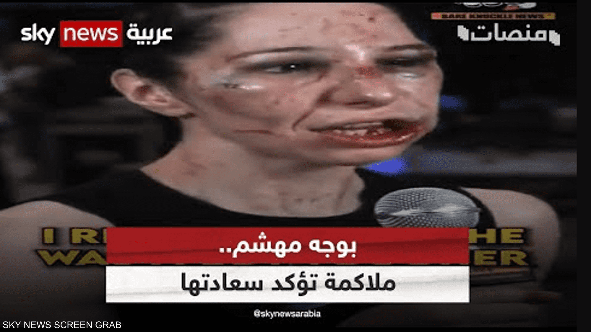 بوجه مهشم.. ملاكمة تؤكد سعادتها