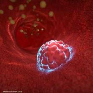 أمل كبير لمرضى سرطان الأمعاء