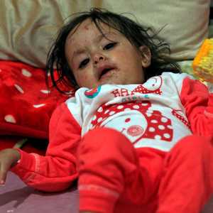 طفلة تعالج من الإصابة بالحصبة (أرشيفية)