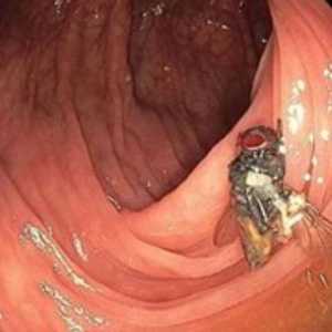 في حالات نادرة تفقس بيوض الحشرات داخل الأمعاء