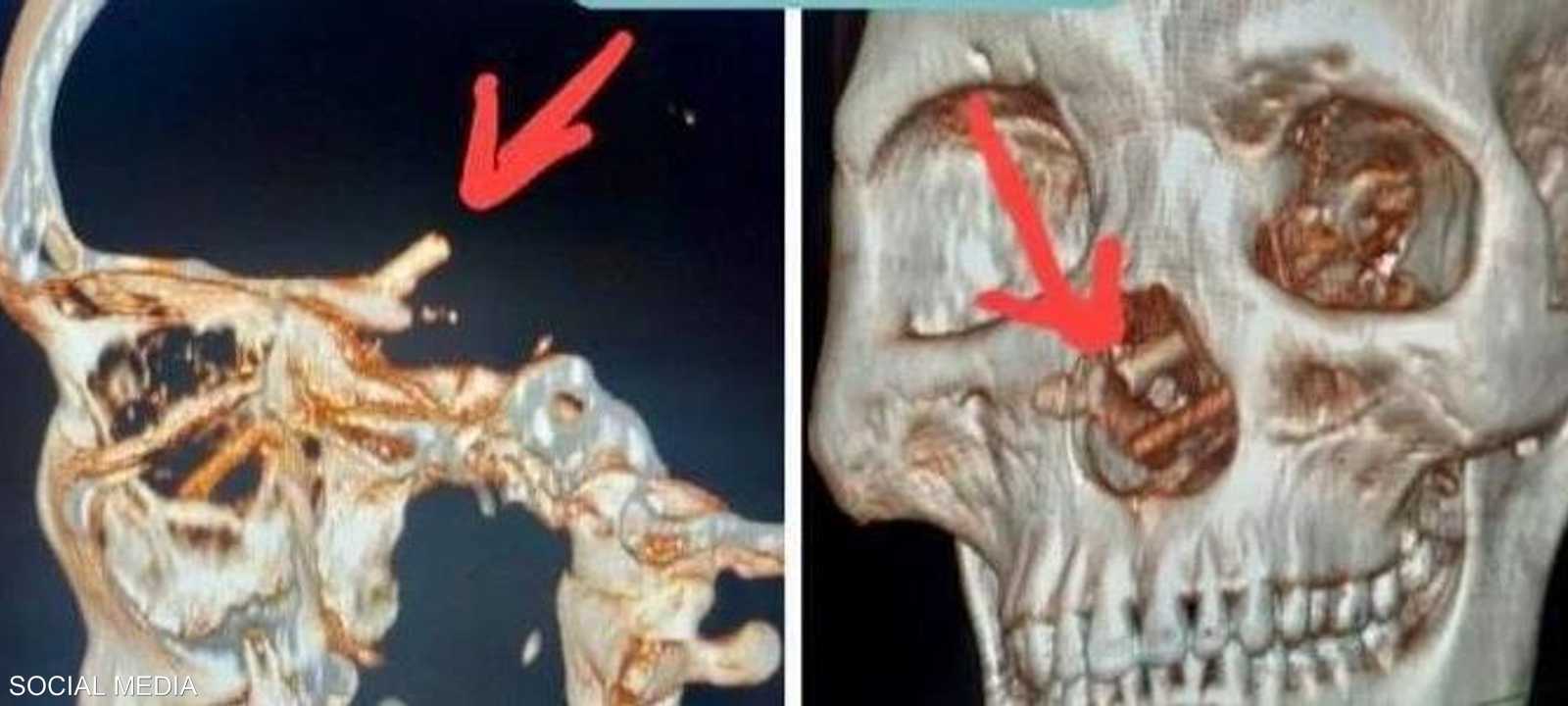 بدء الرجل يفقد بصره تدريجيا