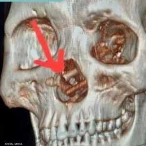 بدء الرجل يفقد بصره تدريجيا