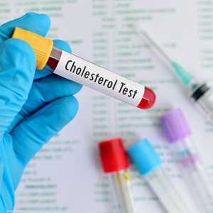 أرشيفية لاختبار نسبة الكوليسترول في الدم