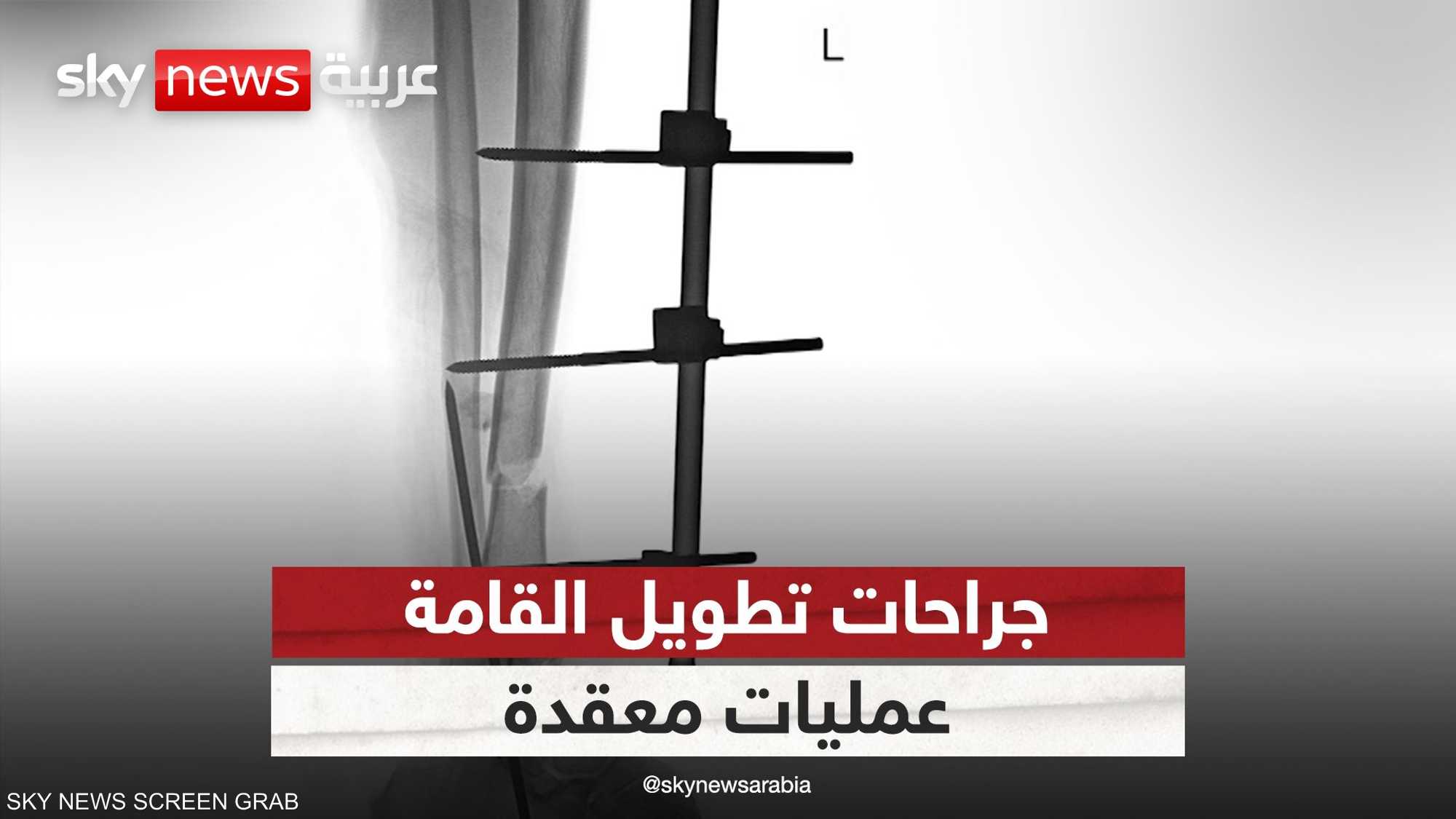 جراحات تطويل القامة.. عمليات معقدة وتكلفة باهظة